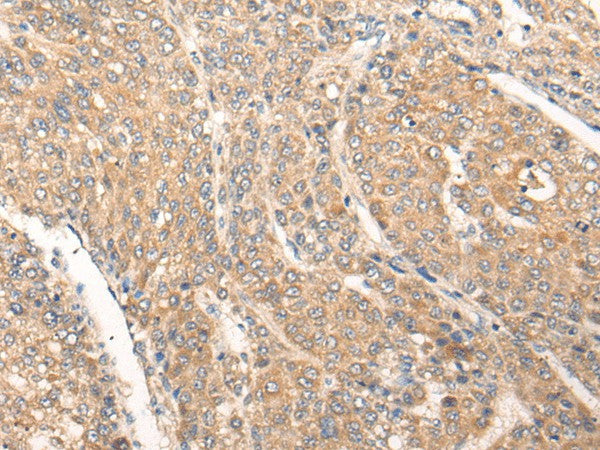 Immunohistochemistry of paraffin-embedded Human liver cancer tissue using PIAS3 Polyclonal Antibody at dilution of 1:40(×200)