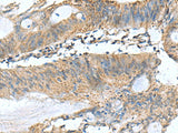Immunohistochemistry of paraffin-embedded Human colorectal cancer tissue using PAFAH1B3 Polyclonal Antibody at dilution of 1:60(×200)