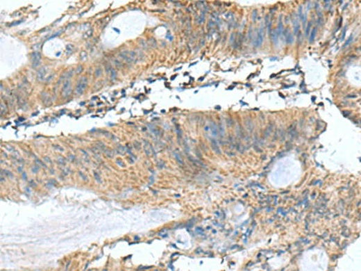 Immunohistochemistry of paraffin-embedded Human colorectal cancer tissue using PAFAH1B3 Polyclonal Antibody at dilution of 1:60(×200)