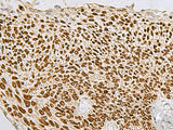 Immunohistochemistry of paraffin-embedded Human lung cancer tissue using TP63 Polyclonal Antibody at dilution of 1:65(×200)