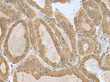 Immunohistochemistry of paraffin-embedded Human thyroid cancer tissue using SLC30A6 Polyclonal Antibody at dilution of 1:75(×200)