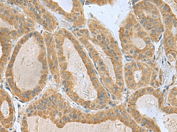 Immunohistochemistry of paraffin-embedded Human thyroid cancer tissue using SLC30A6 Polyclonal Antibody at dilution of 1:75(×200)