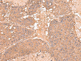 Immunohistochemistry of paraffin-embedded Human liver cancer tissue using AHCYL1 Polyclonal Antibody at dilution of 1:65(×200)