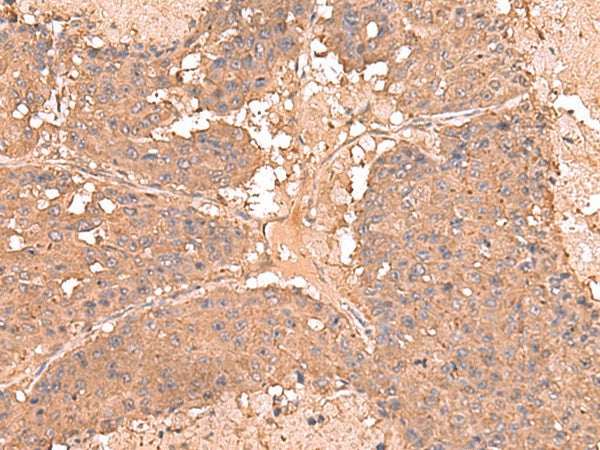 Immunohistochemistry of paraffin-embedded Human liver cancer tissue using AHCYL1 Polyclonal Antibody at dilution of 1:65(×200)