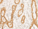 Immunohistochemistry of paraffin-embedded Human breast cancer tissue using RPS27A Polyclonal Antibody at dilution of 1:40(×200)