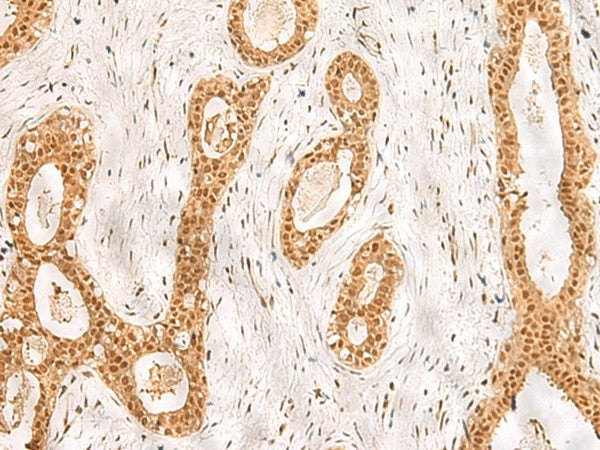 Immunohistochemistry of paraffin-embedded Human breast cancer tissue using RPS27A Polyclonal Antibody at dilution of 1:40(×200)