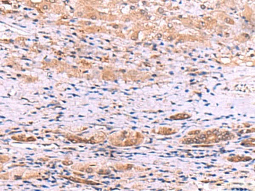 Immunohistochemistry of paraffin-embedded Human liver cancer tissue using DHPS Polyclonal Antibody at dilution of 1:55(×200)