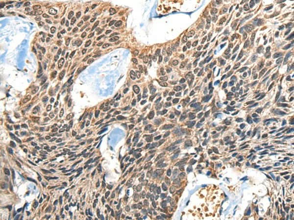 Immunohistochemistry of paraffin-embedded Human esophagus cancer tissue using BOLA1 Polyclonal Antibody at dilution of 1:50(×200)