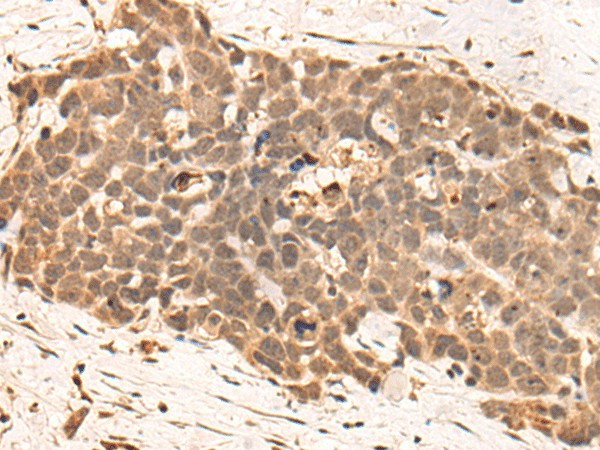 Immunohistochemistry of paraffin-embedded Human thyroid cancer tissue using CLK2 Polyclonal Antibody at dilution of 1:45(×200)