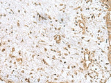 Immunohistochemistry of paraffin-embedded Human breast cancer tissue using AK6 Polyclonal Antibody at dilution of 1:90(×200)