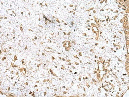Immunohistochemistry of paraffin-embedded Human breast cancer tissue using AK6 Polyclonal Antibody at dilution of 1:90(×200)