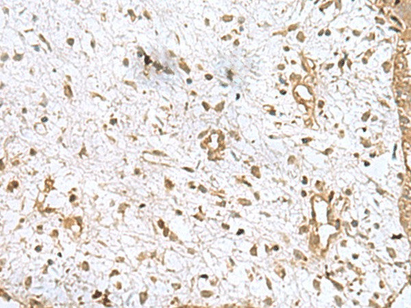 Immunohistochemistry of paraffin-embedded Human breast cancer tissue using AK6 Polyclonal Antibody at dilution of 1:90(×200)