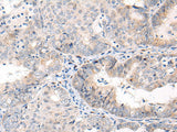 Immunohistochemistry of paraffin-embedded Human ovarian cancer tissue using ANAPC15 Polyclonal Antibody at dilution of 1:70(×200)