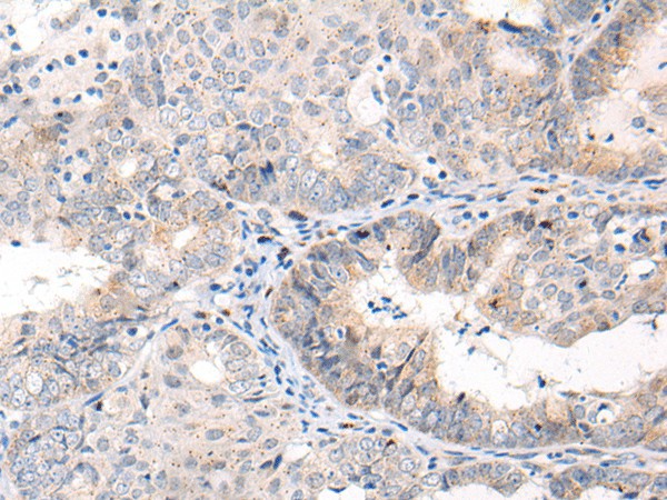 Immunohistochemistry of paraffin-embedded Human ovarian cancer tissue using ANAPC15 Polyclonal Antibody at dilution of 1:70(×200)